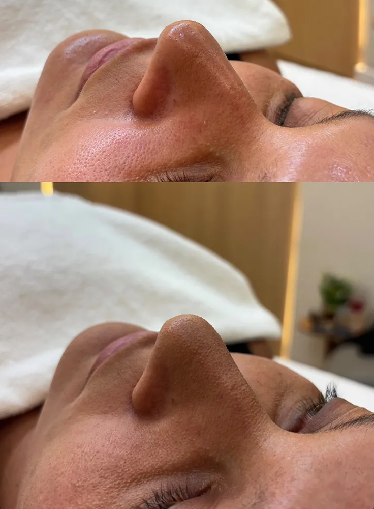 Antes e depois de limpeza de pele: poros visíveis antes, pele mais lisa depois
