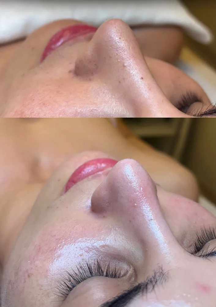 Antes e depois de protocolo facial: pele mais uniforme e iluminada