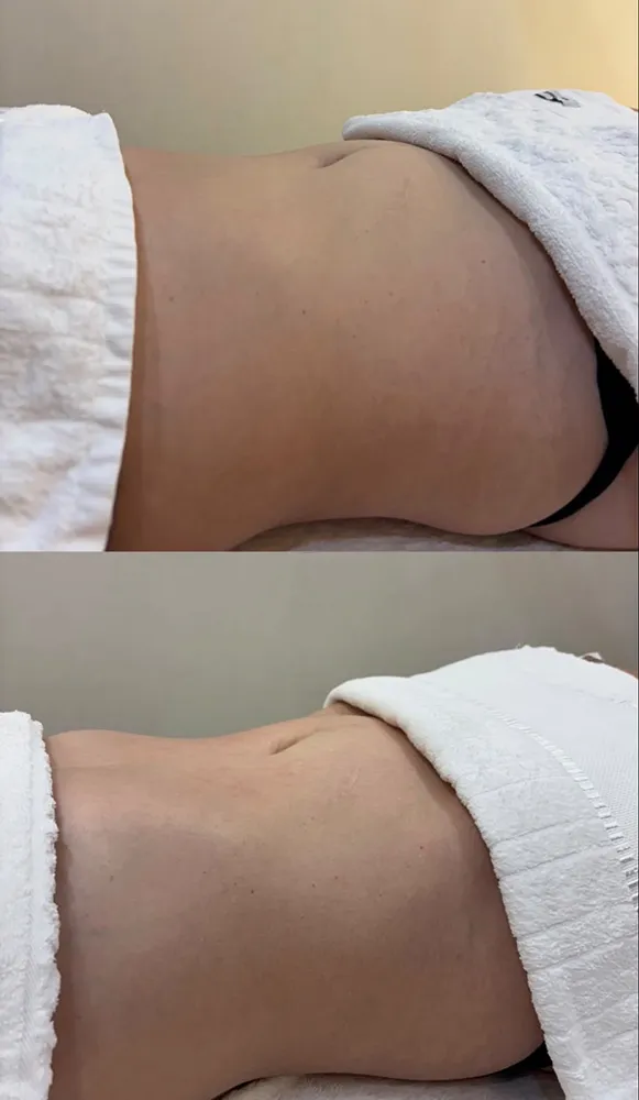 Antes e depois de protocolo corporal: abdômen mais definido
